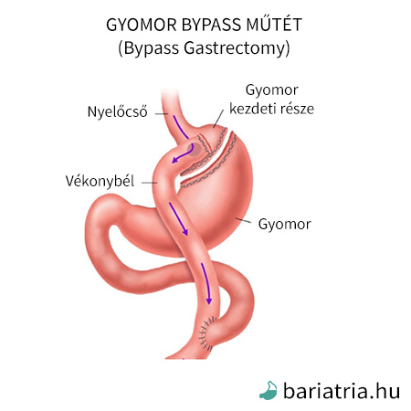 Gyomor bypass – ÉtrendTerápia